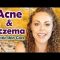 (Video) Natural Acne And Eczema Remedies