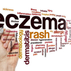 What Are the Best Essential Oils for Eczema and How to Use Them